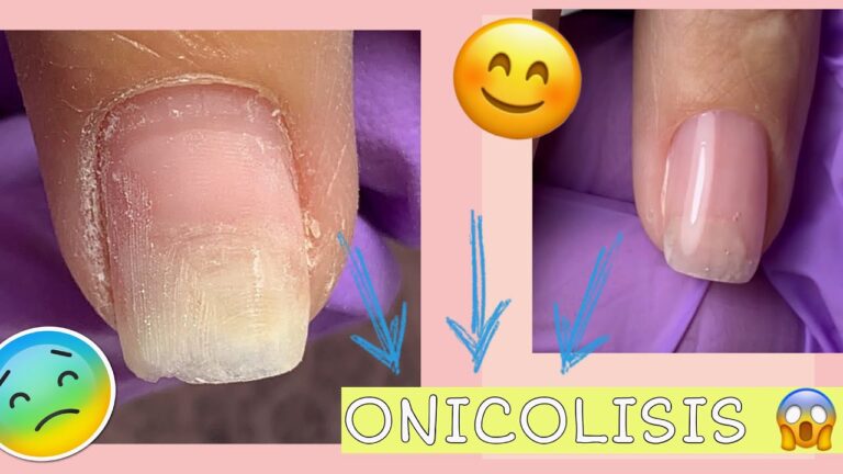 Onicólisis: La novedosa solución estética para uñas perfectas